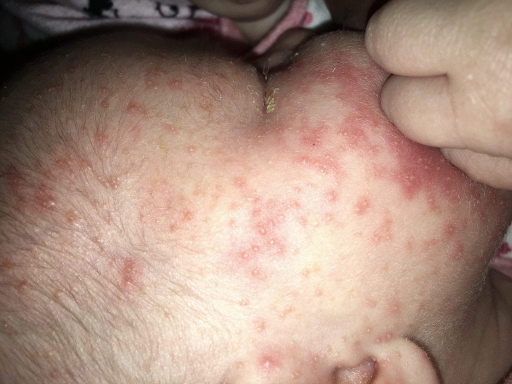 https://meervanmir.eu/baby-acne-kenmerken-puistjes-neonatale-cephale-pustulose/