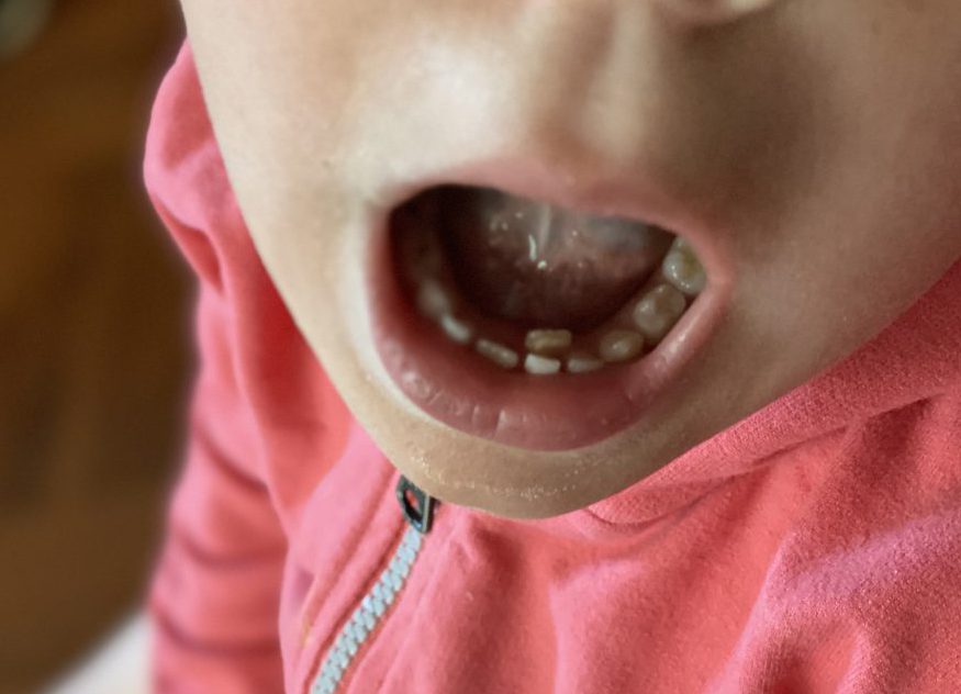 absorptie haalbaar Brullen Dubbele rij tanden kind: haaientanden, wisselen en wat nu? - MeerVanMir
